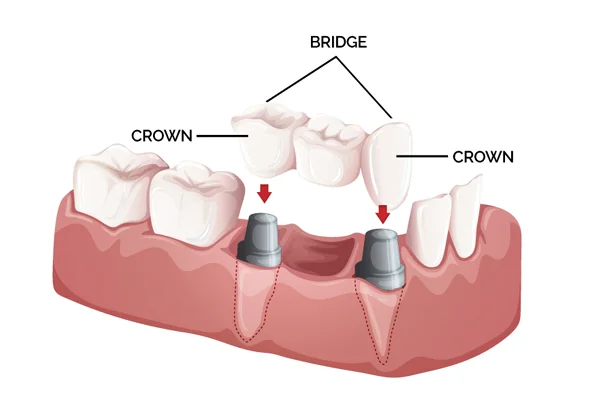 Crown & Bridges