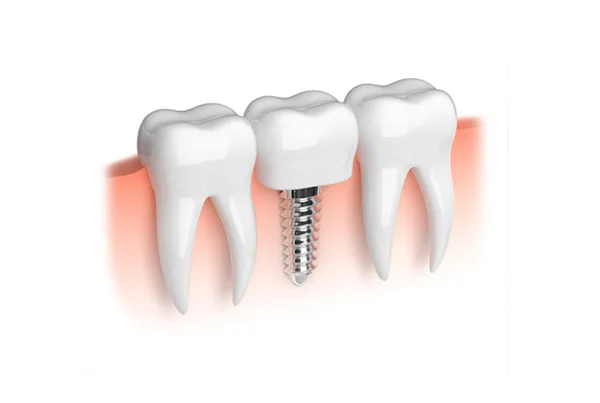 Dental Implant