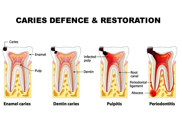Caries Defence & Restoration