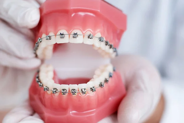 Braces